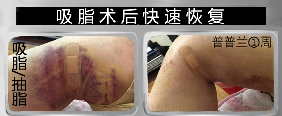 Phục hồi nhanh chai tinh dầu Puplan nhỏ bạc sau khi hoạt động Cửa hàng chính hãng số 1059043 - Tinh dầu điều trị tinh dầu oải hương
