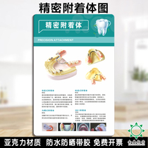 Acrylic Precision Attachment Porcelain Tooth Caries Development Stomatological Hospital Poster Dental Clinic Wall Chart Customization