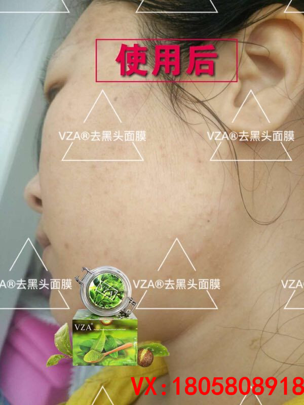 Việt Nam đích thực Surrieo Xian 丫 VZA để mụn đầu đen mụn trứng cá rách sạch lỗ chân lông thu nhỏ kiểm soát dầu mặt nạ cho da dầu mụn lỗ chân lông to