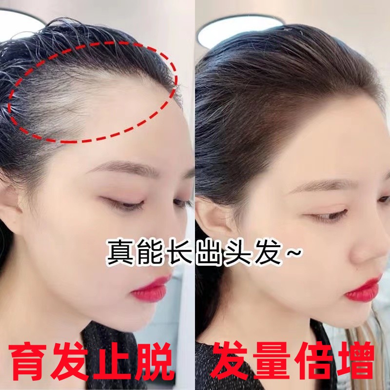 Prevent hair loss from dense hair in men and women and hair growth rate naturally