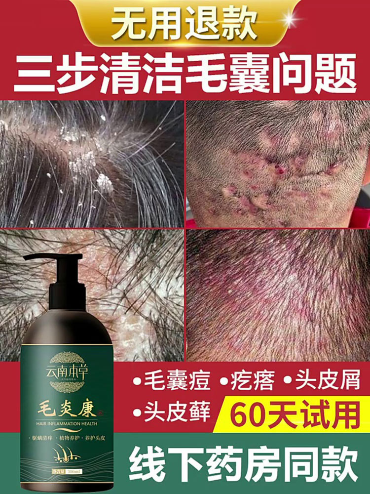 Scalp hair follicles remove mites dandruff inflammation amino acid shampoo dew mite dandruff anti itching oil control cleansing artifact