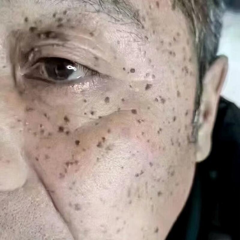 Negotiable Price for Laser Tattoo Removal, Eyebrow Removal, Freckle Removal, Mole Removal, and Age Spot Removal