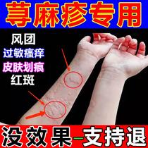 Urticaria allergy to stop itching dugong special ointment rubella millet rash bacteria skin itching wind troupe eczema nemesis