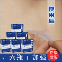 Six bottles) Losar official website scar cream pimple paste hyperplasia surgery light melanin acne pit print