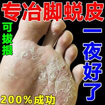 Special cream for peeling soles of soles and peeling soles of soles removing rough dry and cracked skin on feet to remove callus roots