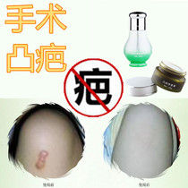 Removal of proliferative body constitution repair of bumps and convexities softening of pimples surgery for cuts Bahenling removal surgery postpartum bruise medicine
