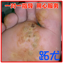 Li Guanghua removes long blood cell spines on the soles of the feet inlaid with black spots meat orangutans corns toe extensions plantar warts especially good