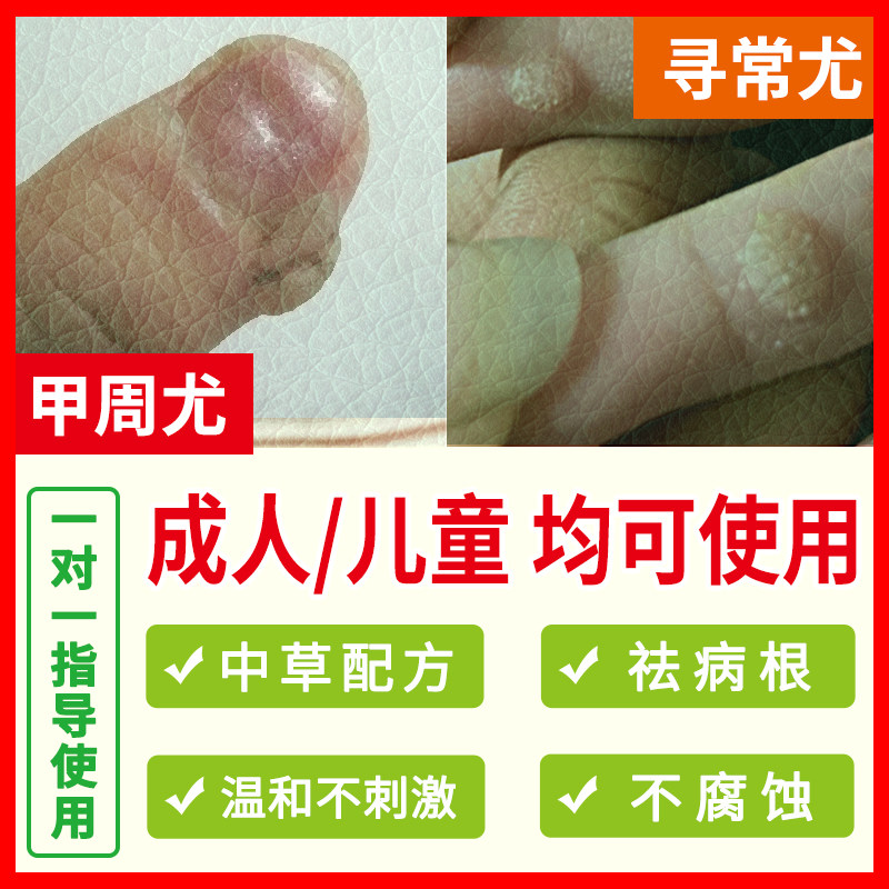 Children's fingers, long corns, thorns, Li Guanghua, Zhou wart, under the armor