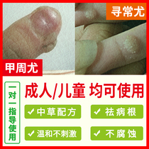 Children childrens fingers long corns meat thorns Li Guanghua peripheral warts lower common warts peripheral warts Xiuxiuzi