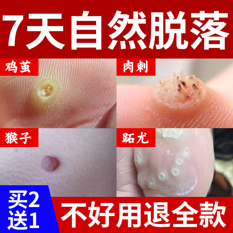 Youjing plantar wart cream Prickly monkey monkey meat prickly meat pelican root special non-wart removal Non-artifact Non-removal Non-medicine