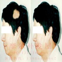 Simulation scalp hair repair soup injury hair loss mens one dollar coin small scars Ultra-thin imported PU inlaid hair