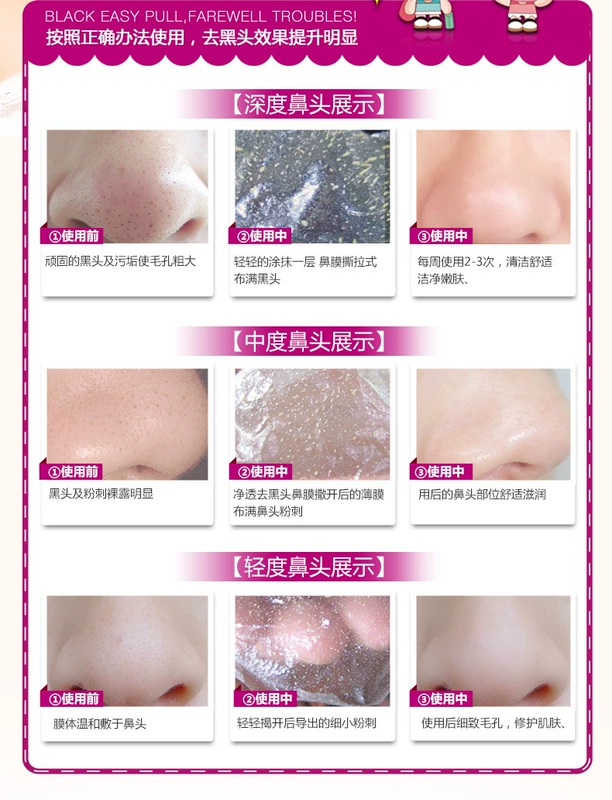泉 雅 面 Mặt nạ Aloe Vera để Blackhead Hydrogel Cream To Whitehead Mask Tear-Off Nasal Membrane - Mặt nạ