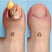 The bacteriostatic non-decchia sooner or later the effect is too good for a bad nail to change a good A finger toe repair to a good potassium