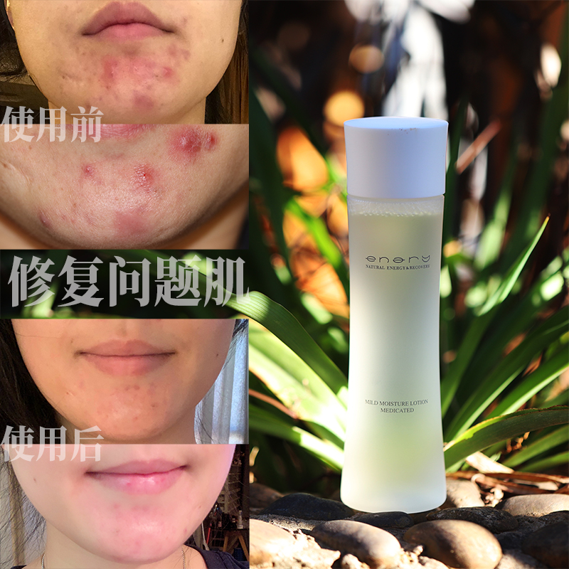 Anti-acne repair cuticle Japanese enary chitin water moisturizing moisturizing oil control sensitive essence toner