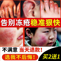 Freezing sore paste to cure root-swelling anti-freeze frostbite freezing hand facial foot heel dry cracked anti-cracking red swollen repair cream
