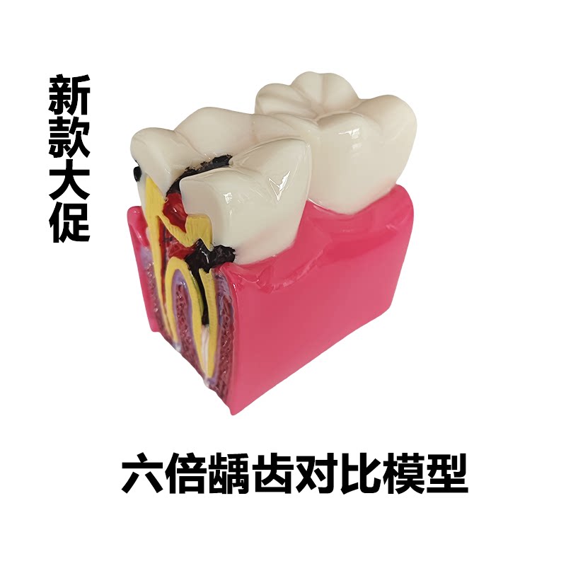 牙科口腔6倍龋齿对比模型 蛀牙龋坏演变过程 医患教学沟通 包邮