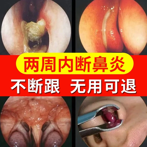Японский ринит распылительный аллергический синусит ринит носовой носовой гипертрофический назальный застой и носовые артефакты