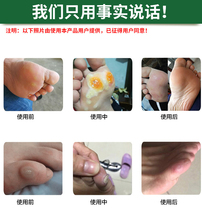 Chicken Eye Ointang Tongrentang Wrazi Foot Membrane Foot 6 Sticks Toe Foot Paste to Hand to Youlingtuo Meat