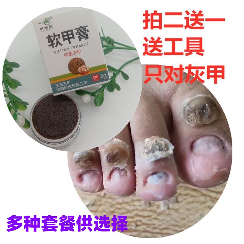 Onychomycosis Nail Removal Cream, Soft Nail Cream, Softens Nails, Removes Nails, Nail Removal Essential Oil, Onychomycosis Remover, Removes Thickening and Discoloration, Kills Fungi