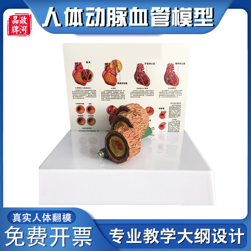 教学仿真血管模型活动血管阻塞模型血栓病变标本4阶段性动脉模具