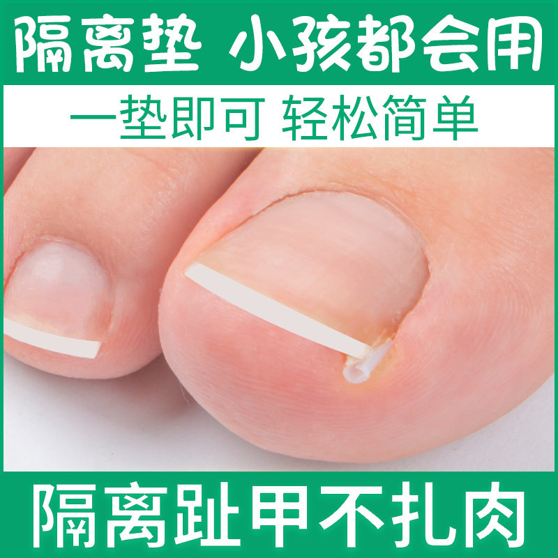 脚指甲甲沟填充垫片趾甲垫片隔离扎长肉里嵌甲神器炎