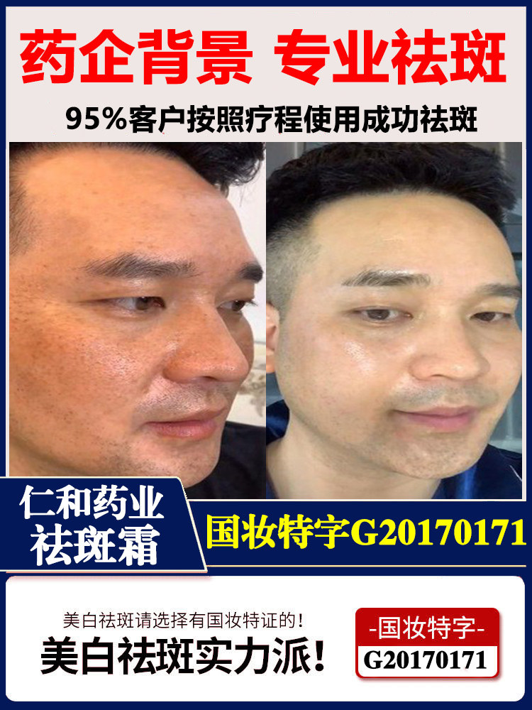 Freckle cream freckle genetic spot removal artifact for men's special whitening light spot chloasma age spots to buy