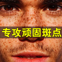 Freckle artifact mens special freckle cream whitening desalination stains remove chloasma freckles old domestic