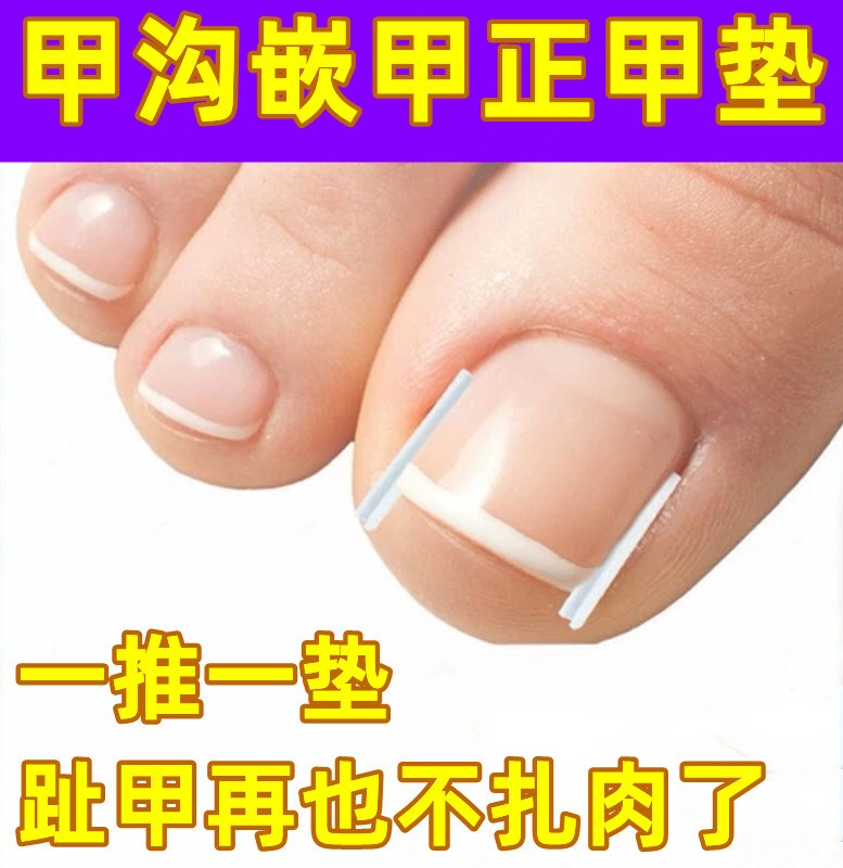 Ingrown Toenail Correction Device, Specialized Isolation and Filling Pads for Correcting Toenails That Grow into the Flesh