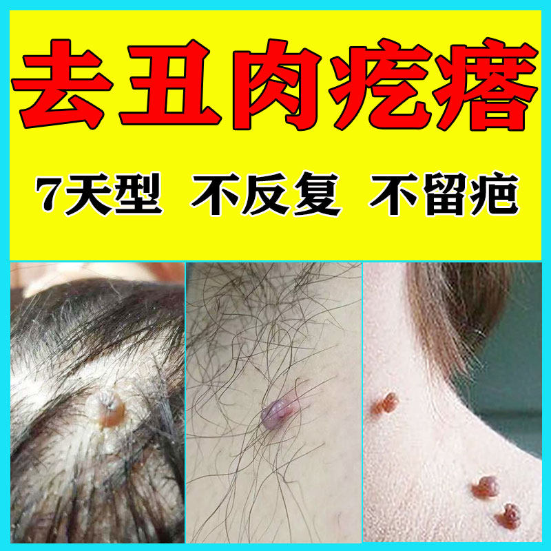 Get rid of monkey neck long small meat pellets Pimple armpit mole removal cream mole medicine point Meat mole Convex mole artifact