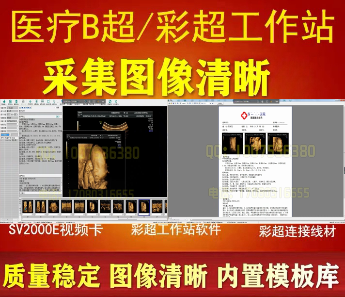 Ultrasound workstation software black and white B-ultrasound 3D and 4D color ultrasound software acquisition card cable complete set