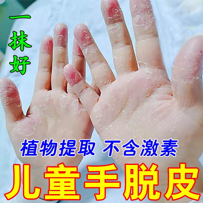 Toddler finger-head metaskin hand peeling severe special ointment Children's hands and feet up to dry off the skin care cream-Taobao