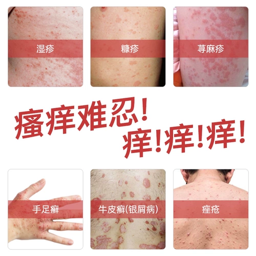 优禾康 Холодный компресс, кожаный гель от экземы, мазь, против зуда