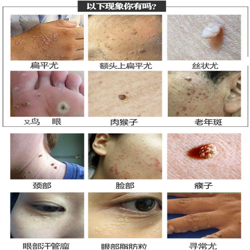 激光去扁平疣/脂肪粒神器？德国小白仪器真能搞定眼皮疣吗？-其它面部美容仪-淘宝百科网