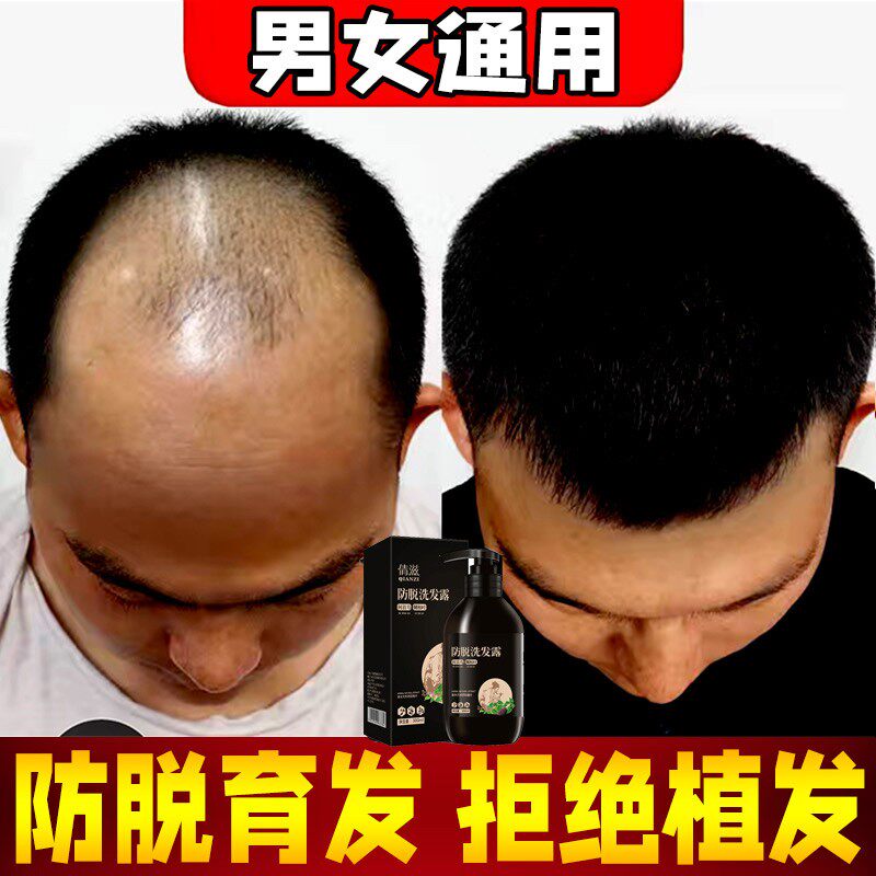 Polygonum multiflorum anti-hair loss shampoo arborvitae ginger hair loss serious women's men's special oil control anti-dandruff itching