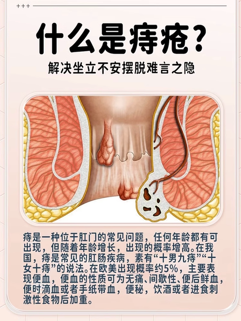 Medical Carbomer Cold Compress Gel for Eliminating Hemorrhoids, Official Anal External Hemorrhoid Treatment