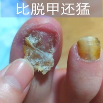 Its too good to not fix it sooner or later its too good a bad nail to change a good A finger toe to repair a good potassium