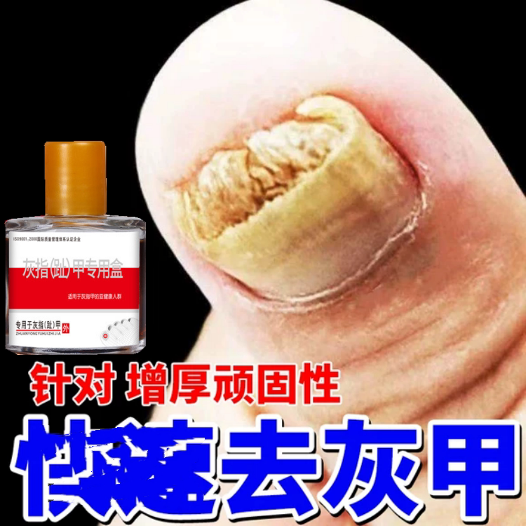 Thickened Toenails Turn Yellow, Black and White Nails Separate from the Nail Bed, Repair Bright Gray Nails, Genuine Thick Gray Nail Removal Cream