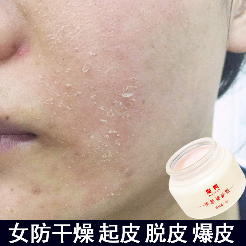 Female Spring Winter Face Skin Dry Skin Burst Leather Dry Skin Salvation Stars Fall Peel Back Peel Dry Cracked Face Cream Pasta Cream