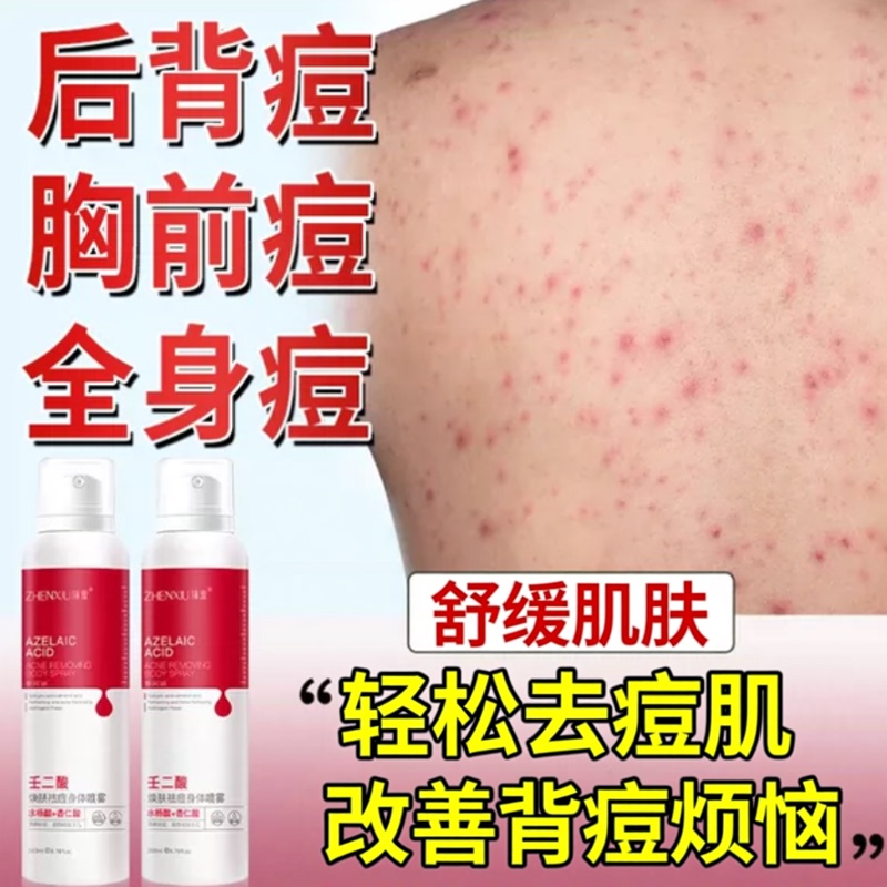 Back Acne, Folliculitis, Mite Removal, Anti-Acne and Anti-Itch Spray for Back, Chest, Arms, and Upper Arms Back Acne, Folliculitis, Mite Removal, Anti-Acne and Anti-Itch Spray for Back, Chest, Arms, and Upper Arms