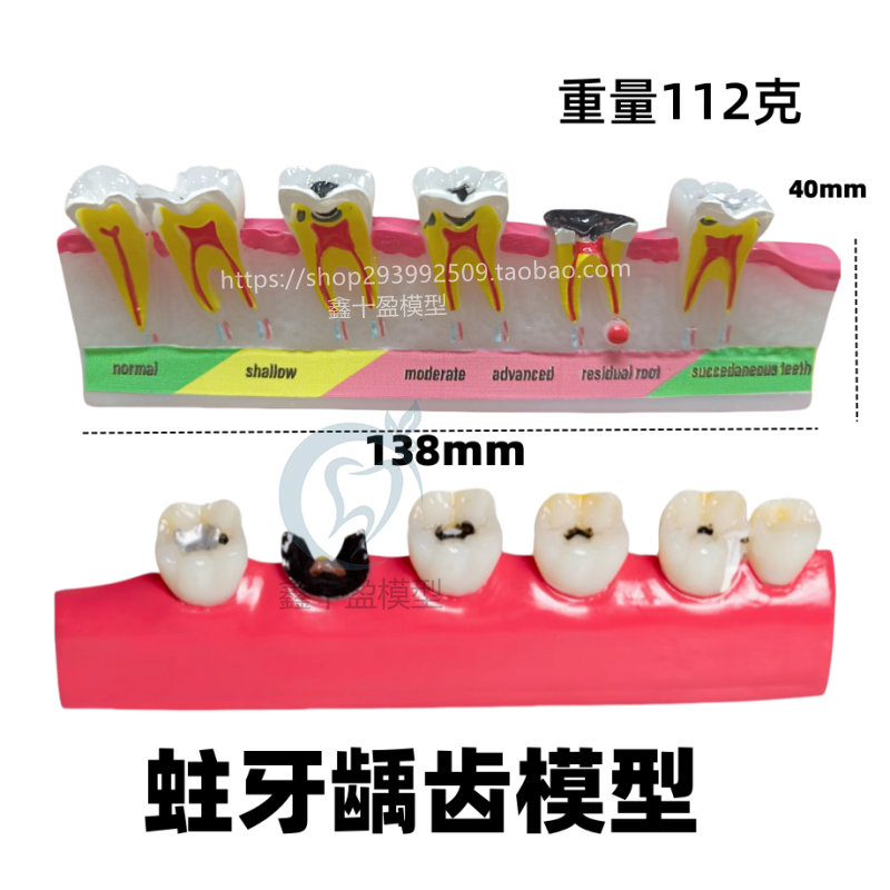 牙齿牙科口腔牙膜牙周分类模型变重过程医患蛀牙沟通教学龋齿展示