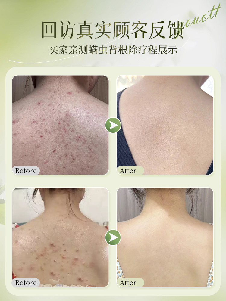 Anti-Mite Shower Gel, Anti-Acne, Back Acid Exfoliation, Long-Lasting Fragrance, Spring and Summer Moisturizing, Official Brand Flagship Store