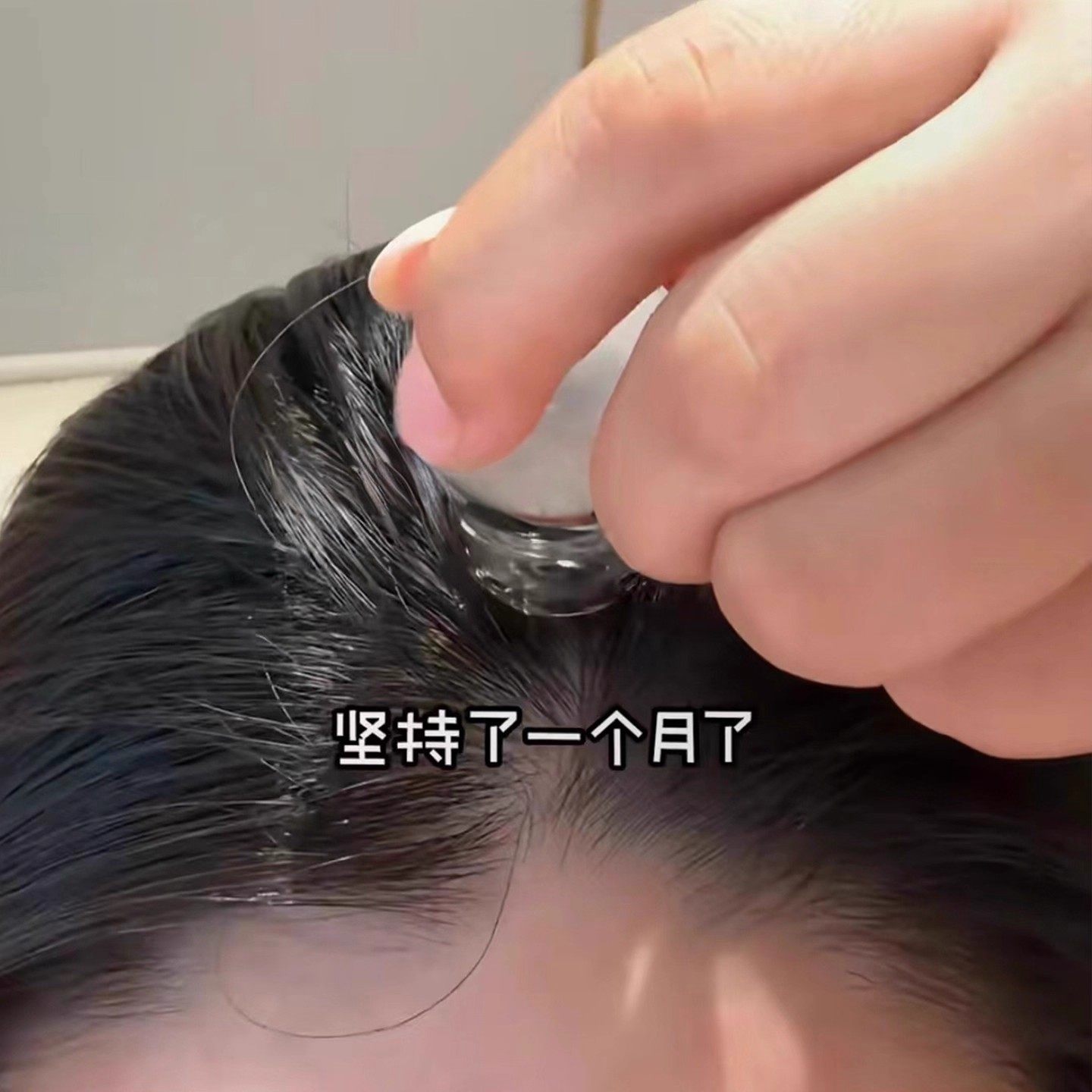 Scalp Applicator Minoxidil 1ml Scalp Applicator Hair Applicator Roller Ball Massage Applicator