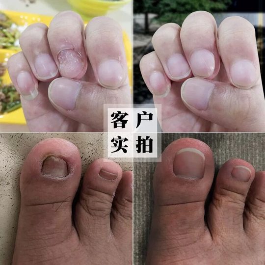 Ремонт поврежденных ногтей, утолщение вогнутых и выпуклых ростов, жидкое средство для восстановления маникюра, регенеративное питательное масло для пальцев и ногтей на ногах