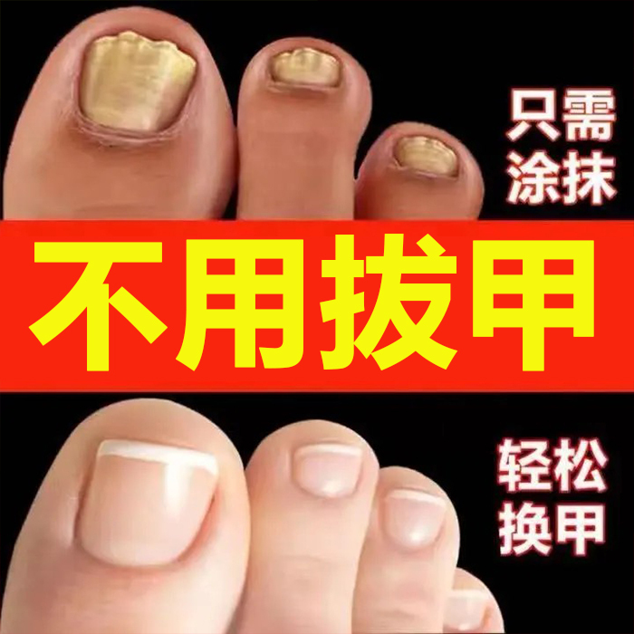 Damaged Nails Thickening Repair Liquid, Nail Growth Liquid, Nail Repair Liquid, Regenerating Nutrient Oil, Finger and Toenail Regeneration