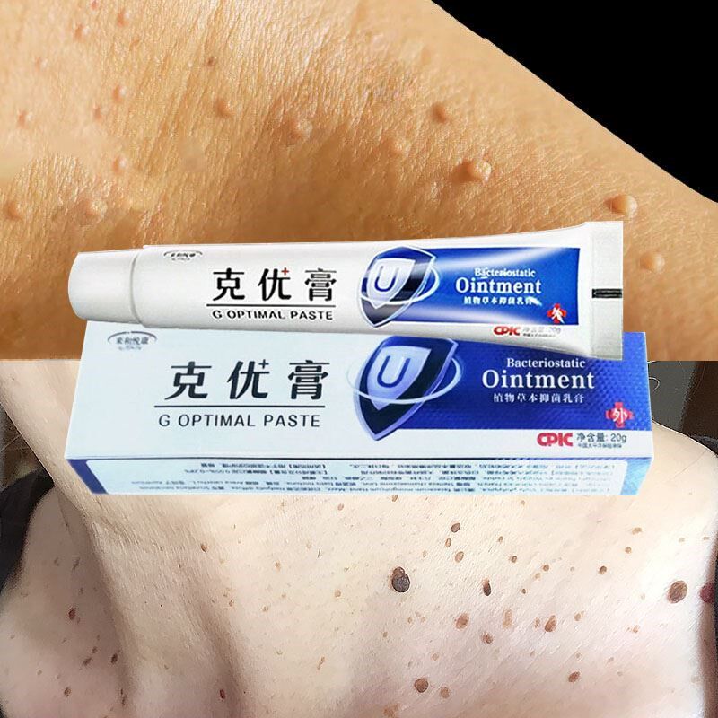 Dispel Yuling Jiak Qing ointment Yubu Pure Cream Yuke Yuke Net Neck Filamentous Flat Uke Yukshu Ointment