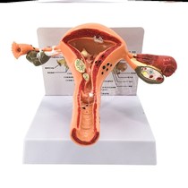Female Reproductive Modeler Model Uterus Model Skeletal Basin Model Anatomical Model Ovarian Pathology Lesion Vaginal Model