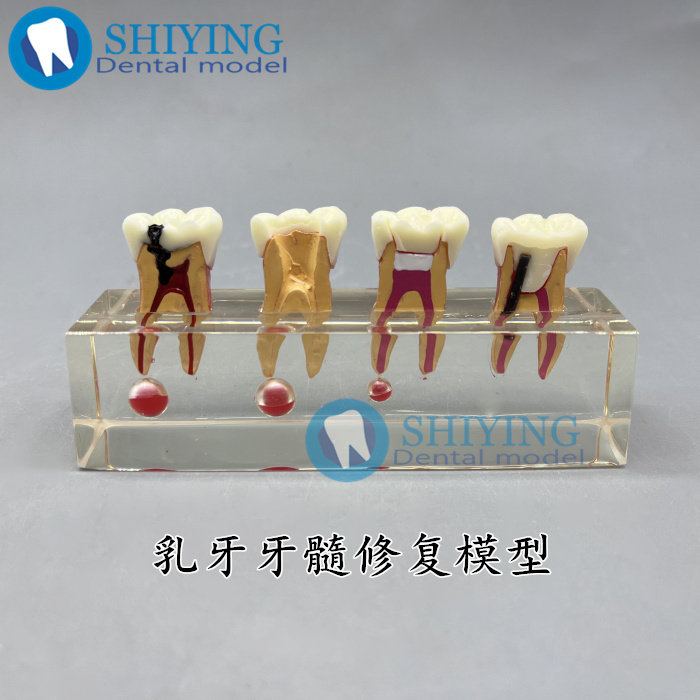 牙科教学模型 乳牙龋病 模型 可拆分牙髓修复 医患沟通 4018 包邮