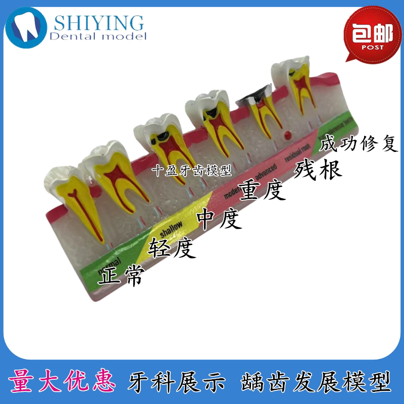 牙科模型病理蛀牙分类牙龈牙周受损口腔展示龋齿演变过程龋齿发展