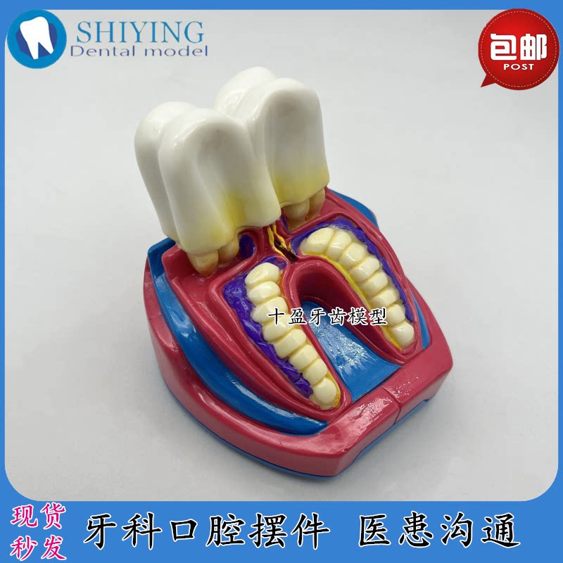 牙科口腔教学模型牙科诊所摆件医患沟通教学教具模型六倍大牙模型