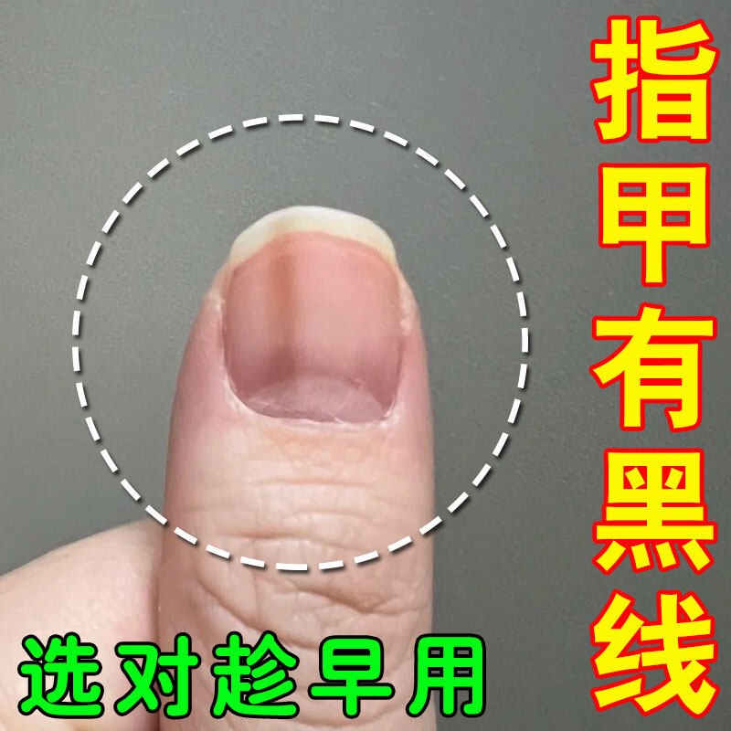 There Is a Black Line in the Middle of the Nail, Causing Pain in the Nail Groove, Redness and Swelling in the Nail Groove, and a Clearly Defined Black Linear Line Appears on the Nail Plate